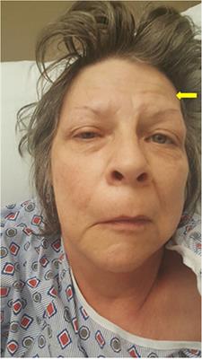 Myasthenia Gravis Masquerading as an Idiopathic Unilateral Facial Paralysis (Bell's Palsy)—A Very Rare and Unique Clinical Find